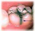 tooth_tsu1.jpg